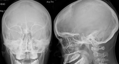 prostitution in punjan nude bone facial fracture